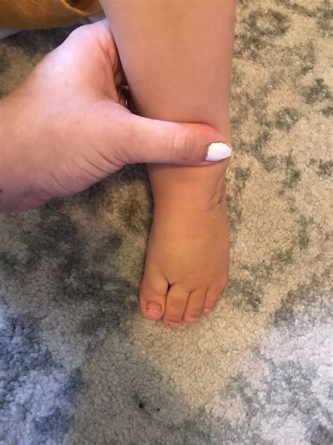 Clubbed Feet Update
