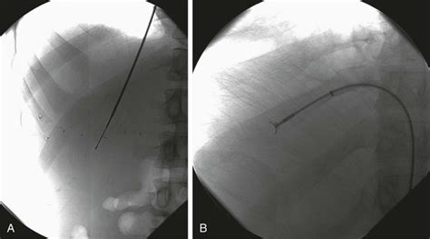 biopsy devices radiology key