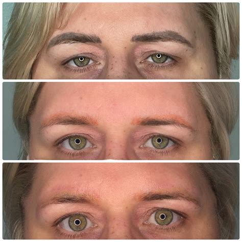 Permanent Makeup Removal Seattle Wa | Saubhaya Makeup