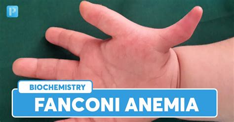 Fanconi anemia: Symptoms, DiagnosisCauses and Treatment