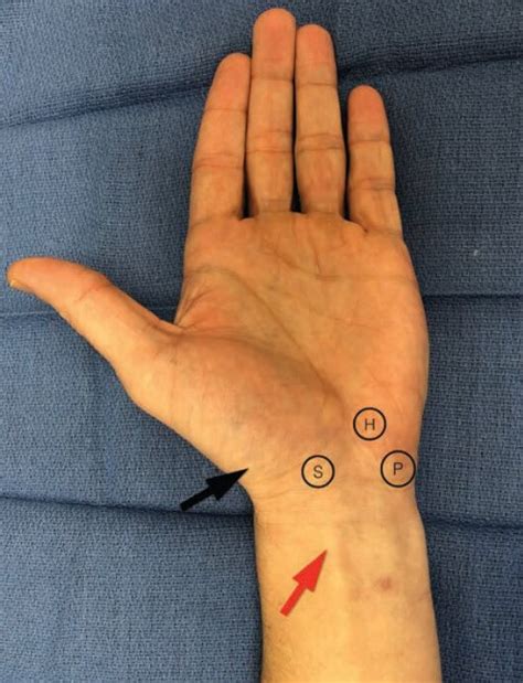 differential diagnosis  ulnar side wrist pain rehand