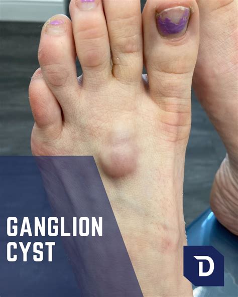 Ganglion Cyst Foot