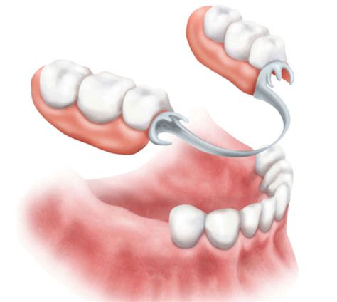 Top 92+ Pictures Pictures Of Partial Dentures For Lower Back Teeth Full ...