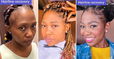 Woman Shares 3 Product Mixture That Grew Back Her Hairline, Video ...