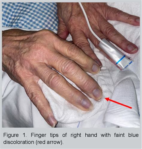 Figure 1 from Acute Upper Extremity Arterial Occlusion Diagnosed on ...