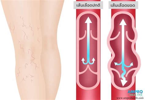 เส้นเลือดขอดและวิธีรักษา - AM Pro Health