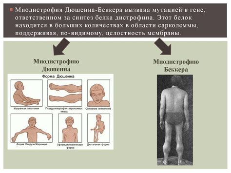 Миодистрофия Дюшенна-Беккера - презентация онлайн