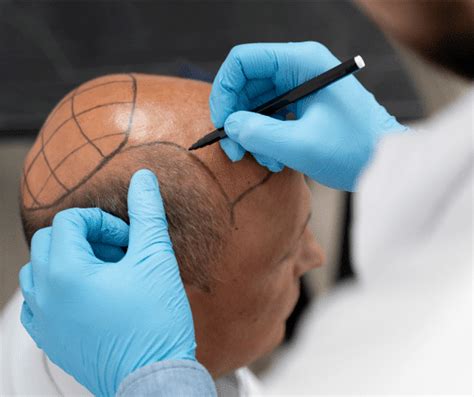ARTAS Robotic Hair Transplant in Dallas, TX | Formula Wellness