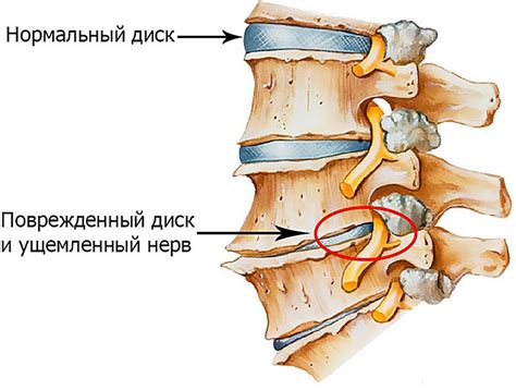 Как восстановиться после защемления нерва в пояснице