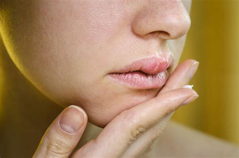 Staph Infection On Lips Swollen | Lipstutorial.org