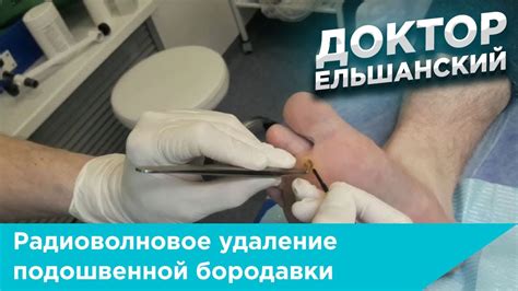 Радиоволновое удаление подошвенной бородавки - YouTube