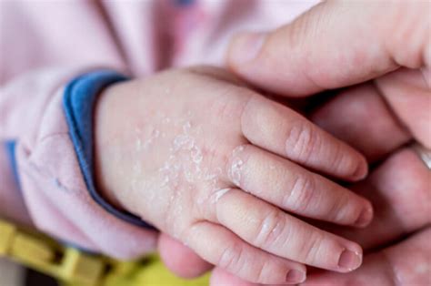 Физиологические причины, которые обуславливают развитие ксероза у детей ...