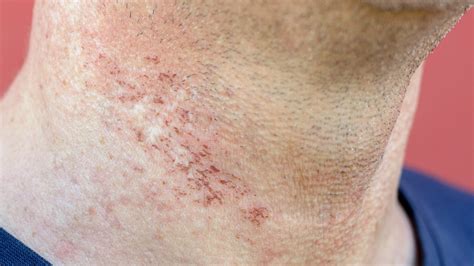 Red Bumps After Laser Hair Removal - 2024 HairStyles Ideas
