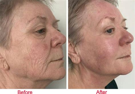 What Is Ultrasound HIFU Beauty Machine 