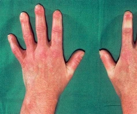 Scleroderma: «Prompt diagnosis saves lives» - Alpha Public Relations