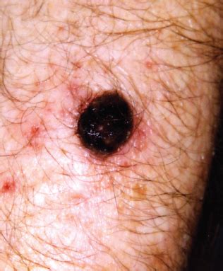 Nodular Melanoma: Definition, Symptoms, Pictures, More, 40% OFF