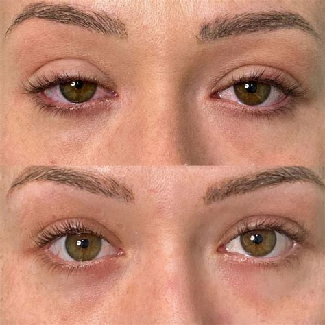 Ptosis - Dr. Murat Sağdık