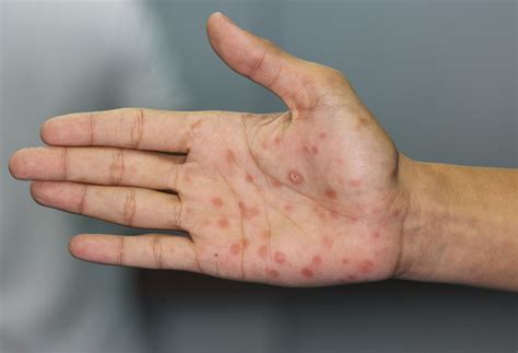 syphilis symptoms risk factors treatment    northwell