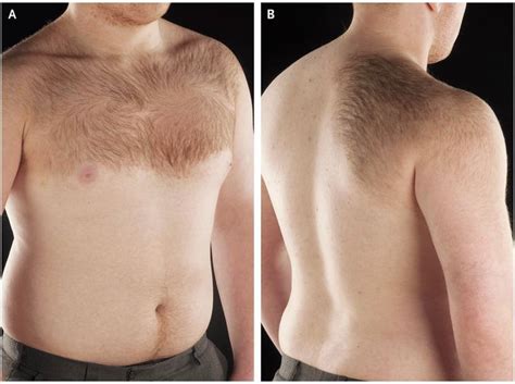 Becker's Nevus - MEDizzy