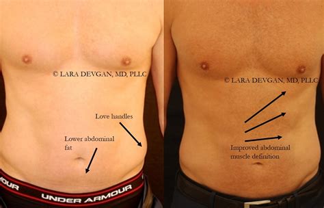 abdominal liposculpture  achieve  amazing  pack lara devgan