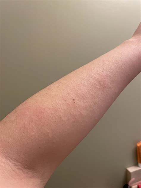 Is this seasonal allergies? What can I do? : r/Allergy