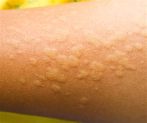 idiopathic urticaria • Dumb Little Man
