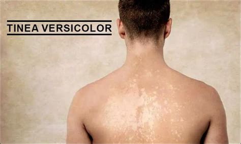 Tinea Versicolor Before And After