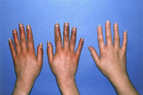 Hands With Acrocyanosis Compared To Healthy Hand Photograph by Science ...