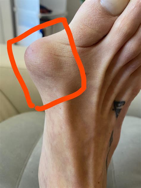 Bunions: Treatment, causes, non-surgical and surgical approaches