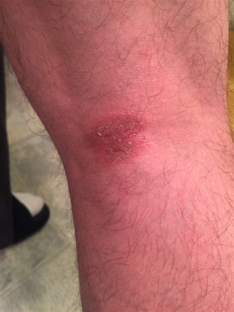 Lyme Disease Symptoms Swollen Knee at Gerard Martin blog