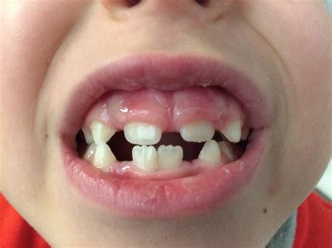 Щель между передними зубами у ребенка 6 лет — 11 ответов | форум Babyblog