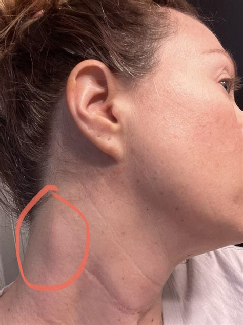 Swollen Lymph nodes : r/thyroidcancer