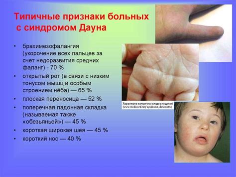 Хромосомные болезни - презентация онлайн