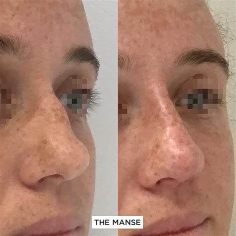 Nose Filler: Non-surgical rhinoplasty at our Expert Sydney Clinic