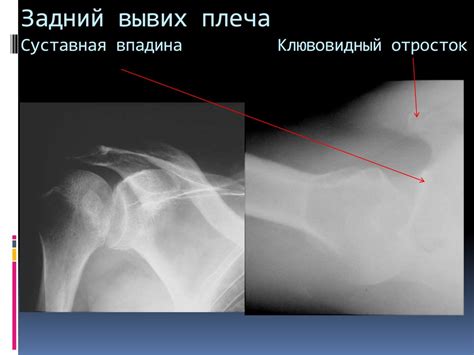 Рентген-диагностика повреждений плеча и надплечья - презентация онлайн