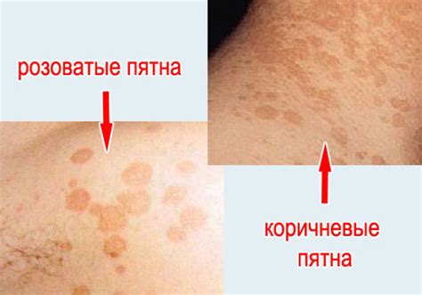 Отрубевидный лишай. Причины, симптомы, признаки, диагностика и лечение ...