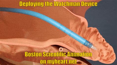 Watchman Device – Explained and FAQ’s Answered by a Cardiologist • MyHeart | Watchmen ...