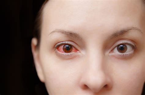 What is Commonly Misdiagnosed as Pink Eye? | Minneapolis