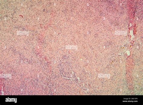 Scars in the heart muscle tissue 100x Stock Photo - Alamy