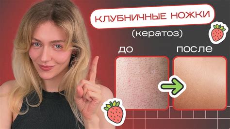 Как избавиться от КЕРАТОЗА и ВРОСШИХ ВОЛОС навсегда - YouTube
