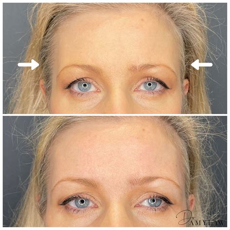 Temple and forehead rejuvenation - Dr Amy Law Cosmetic Clinic Liverpool ...