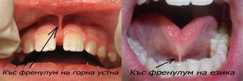 Френулотомия | Д-р Ралев - зъболекар