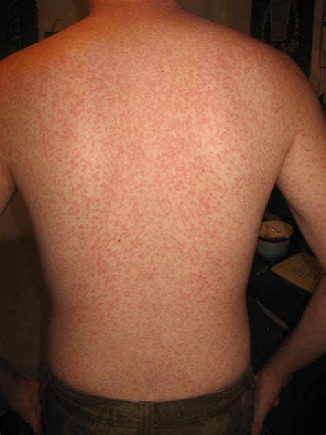 Strep A Rash