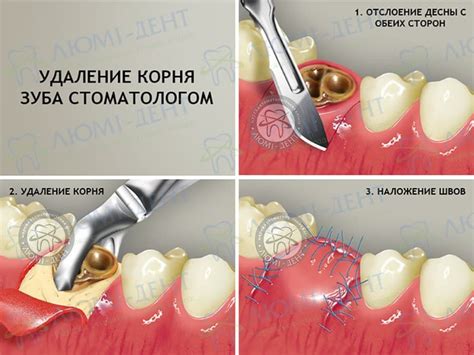 Удаление Зубов Цена Киев Вырвать Клиники ЛюмиДент