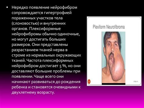 Нейрофиброматоз - презентация онлайн