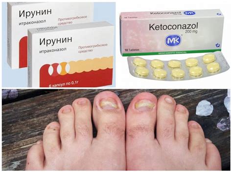 Грибок стопы и ногтей ног: эффективные мази для лечения