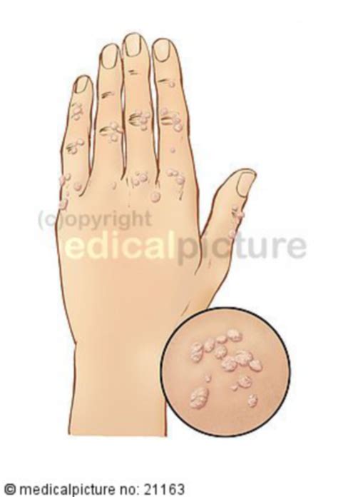 Warts, verruca - DocCheck