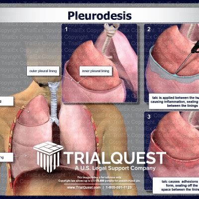 Pleurodesis - TrialExhibits Inc.