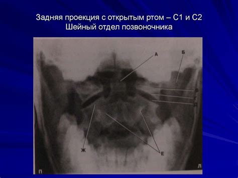 Шестой шейный позвонок, vertebra cervicalis (CVI); вид спереди ...