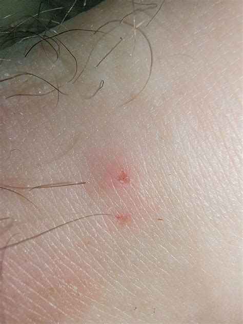 Could this be a bat bite? Sao Paulo, Brazil. : r/BAT
